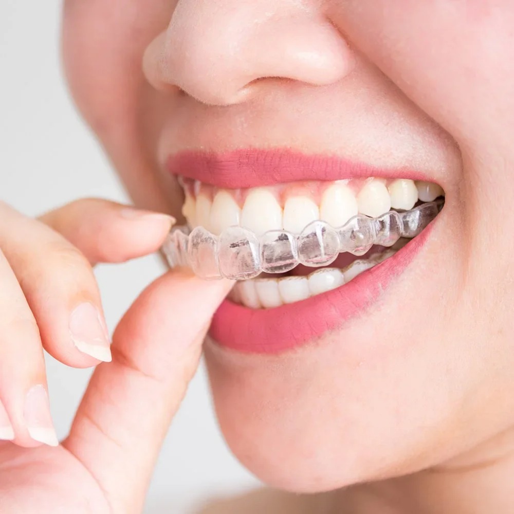 Teeth Whitening Mouth Guard - 1-4 szt. Ochraniacz na usta przeciw