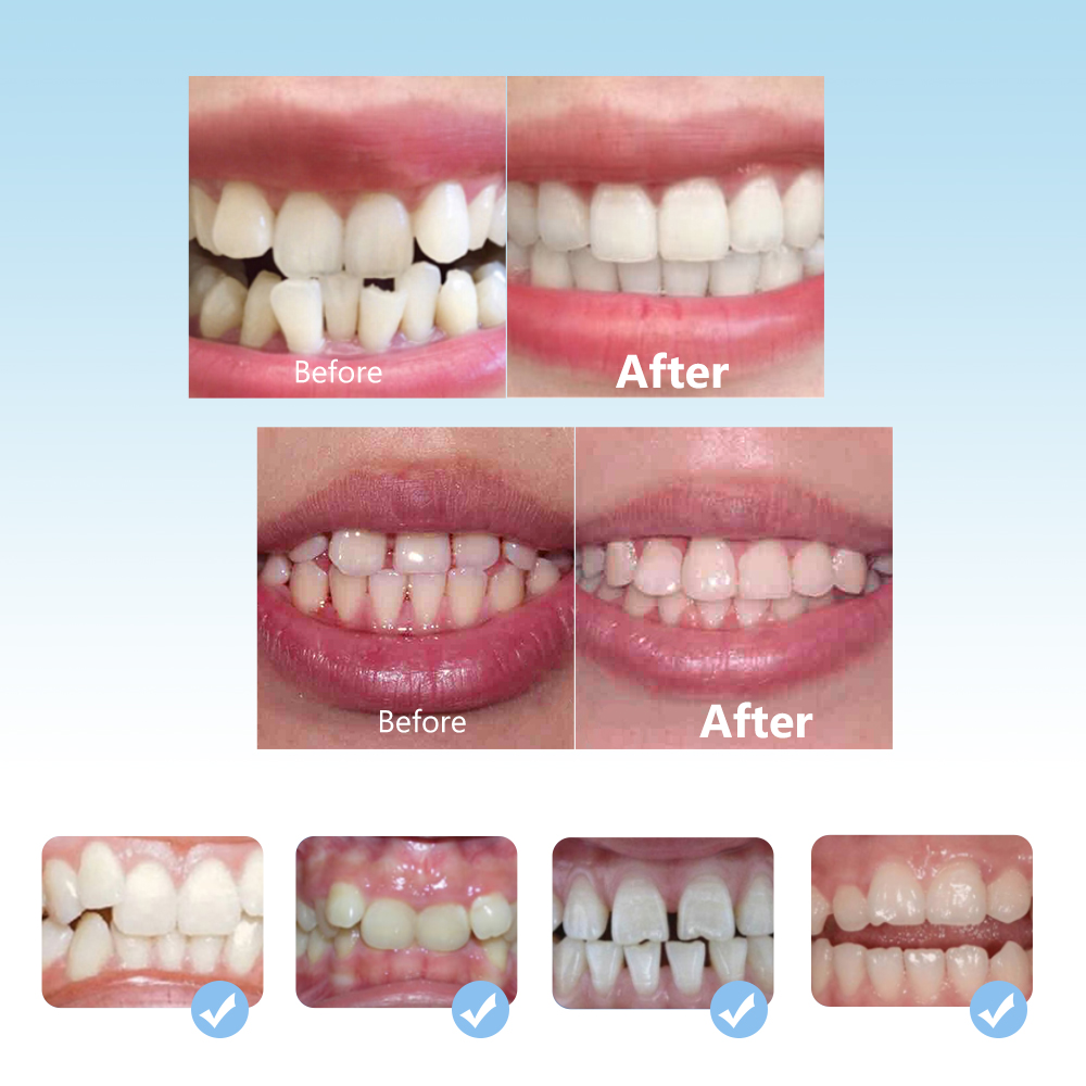 Dental aparaty ortodontyczne z – Teeth Whitening Mouth Guard recenzja i cena
